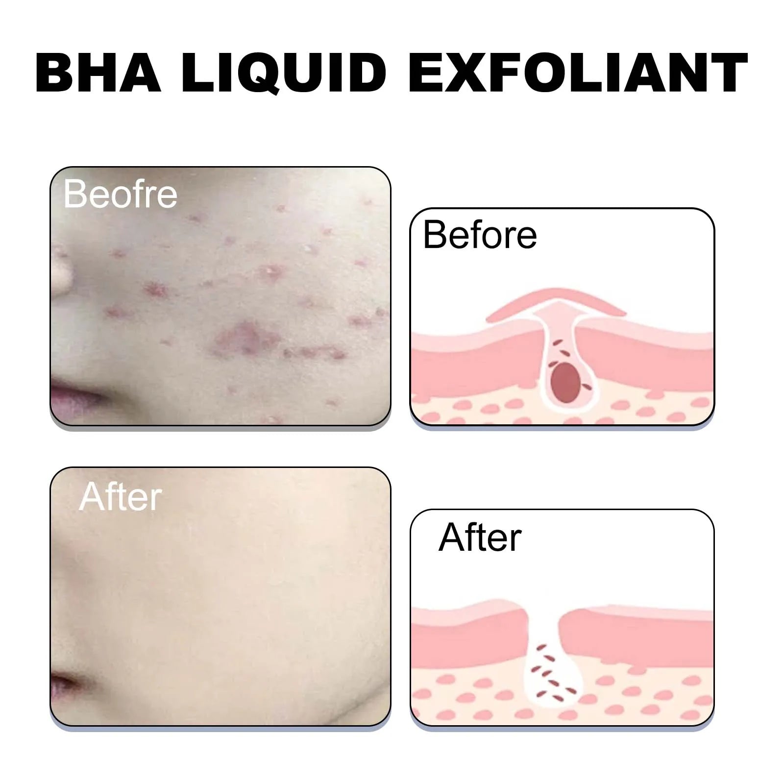 Anti-acne serum piel grasa Korean