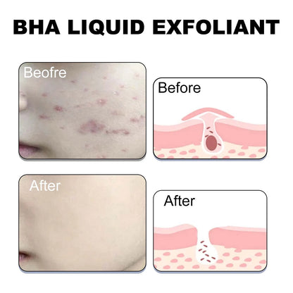 Anti-acne serum piel grasa Korean