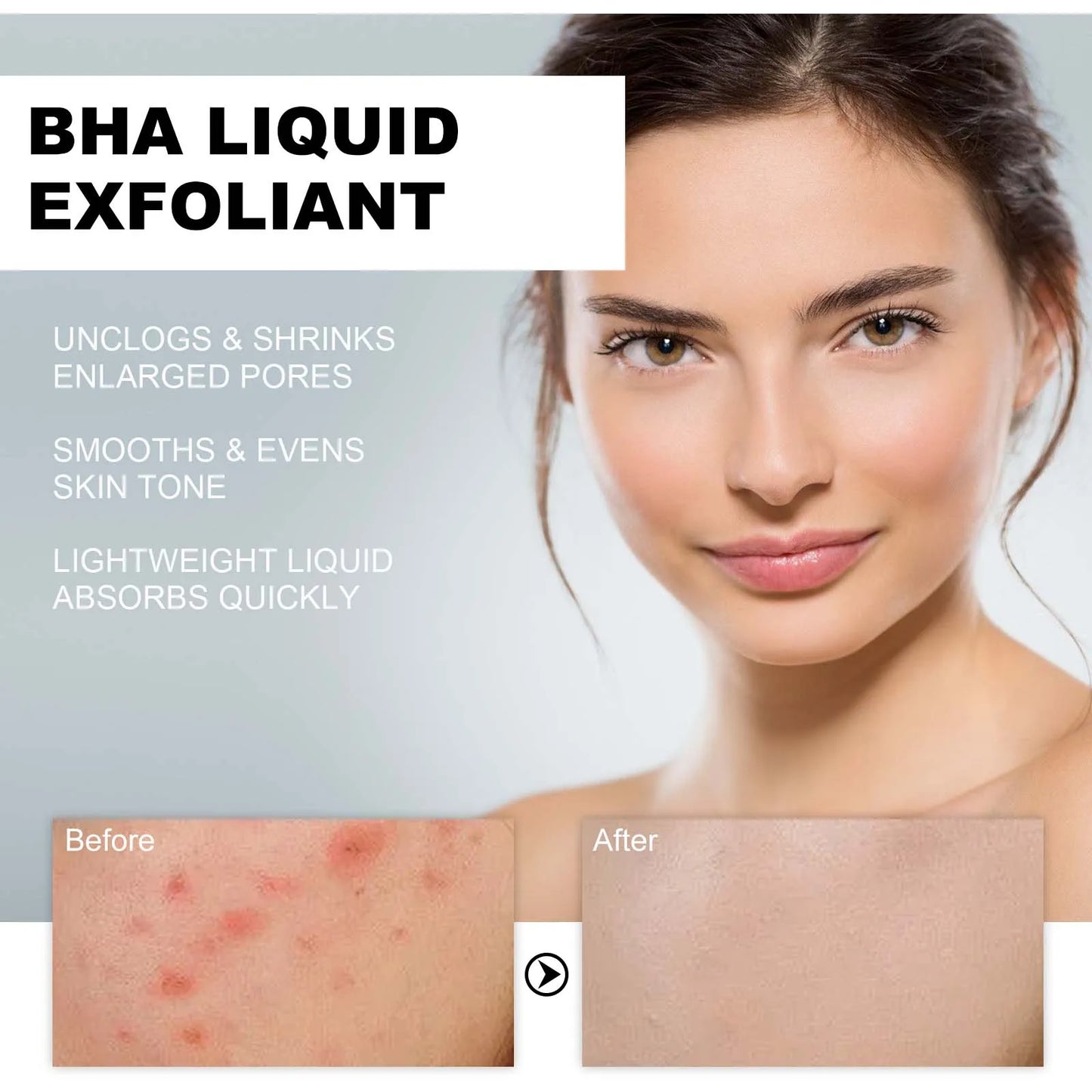 Salicylic acid serum exfoliante piel