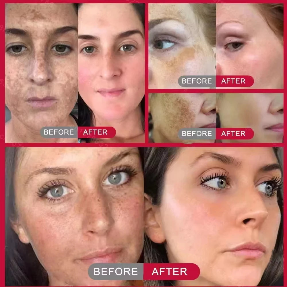 Kojic acid serum resultado piel luminosa