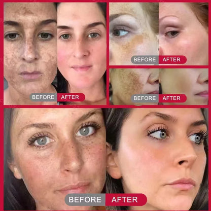 Kojic acid serum resultado piel luminosa