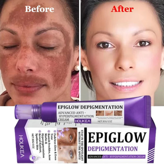Crema aclarante facial manchas melasma