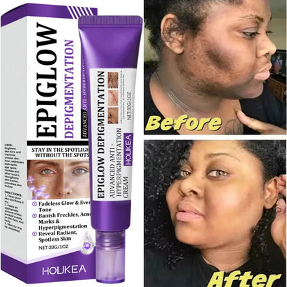 Crema blanqueadora pecas hiperpigmentación