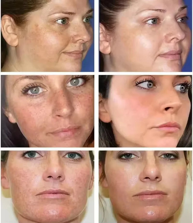 Whitening cream dark spots pigmentation removal